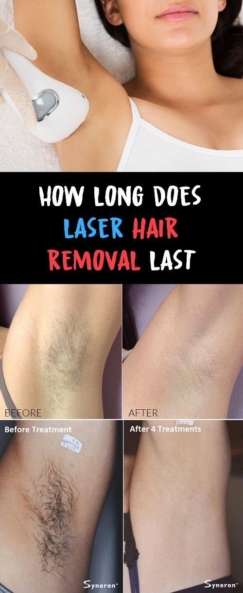 How long does laser hair removal last