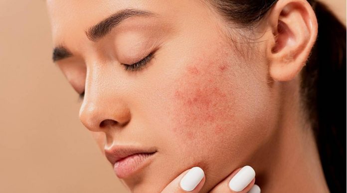 How to get rid of pimples overnight?