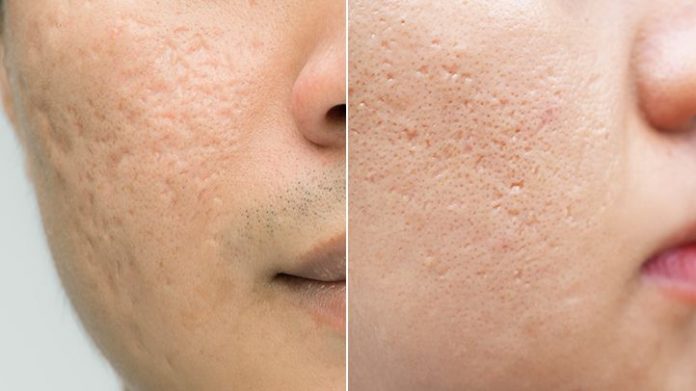 How to get rid of acne scars?