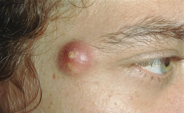 How to get rid of cysts?
