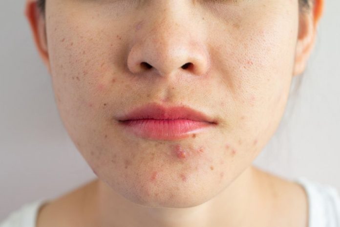 How to get rid of Pimples?